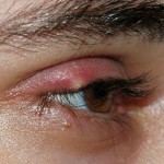 Photo of a stye in the eye/Blepharitis