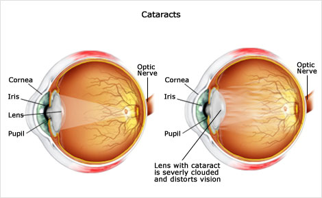 drawing of an eye with and without a cataract