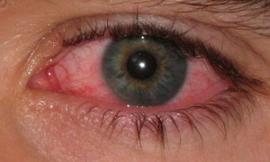 eye infected with conjunctivitis