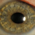 Corneal Transplant (with stitches) courtesy of National Eye Institute