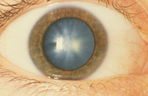 Eye with cataract.