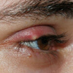 A swollen and red-rimmed eye.